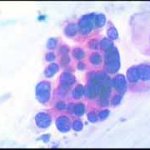 Αδενικών κυτταρων στο Pap-test